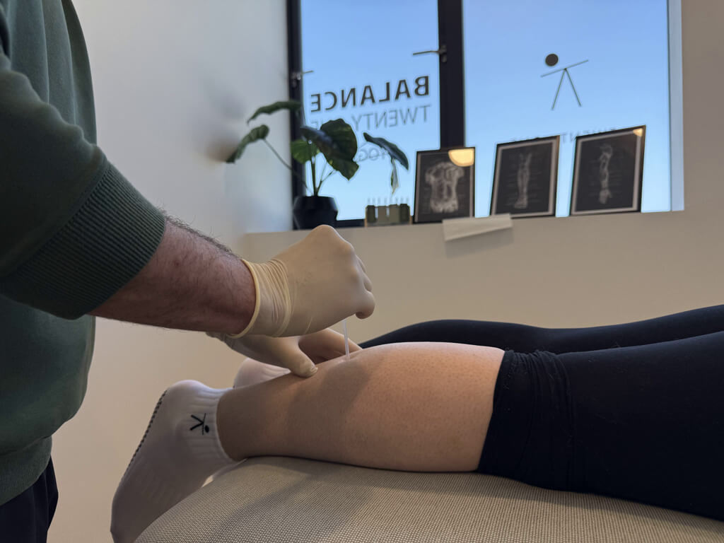 Dry Needling B21 Dry Needling B21