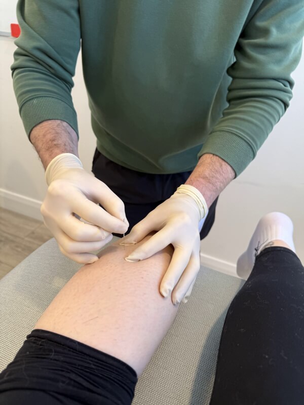 Dry Needling at Balance 21 Dry Needling at Balance 21