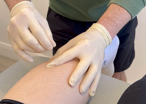Physio-Dry Needling Physio-Dry Needling